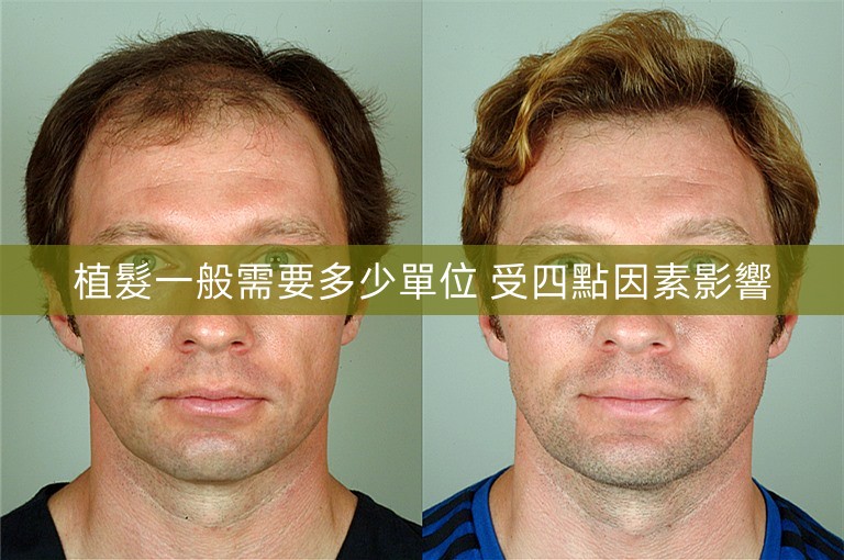 植髮一般需要多少單位 受四點因素影響