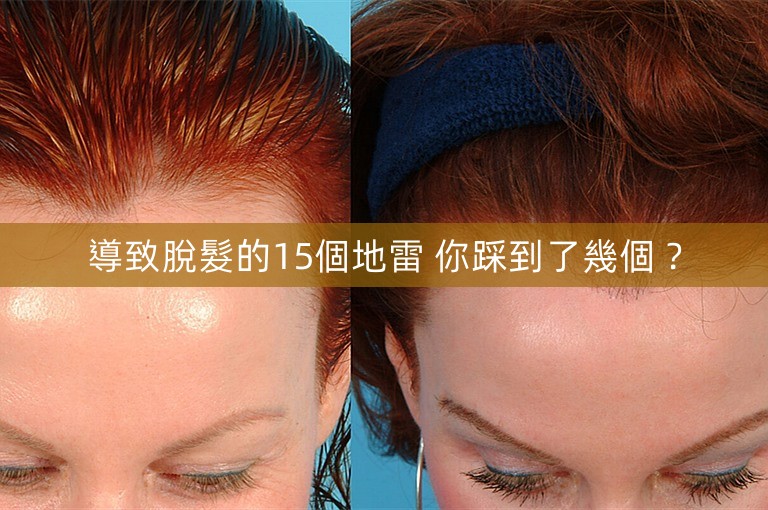 導致脫髮的15個地雷 你踩到了幾個? 導致脫髮的15個地雷 你踩到了幾個?