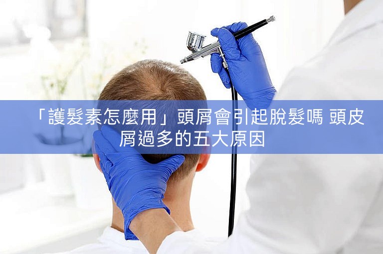 「護髮素怎麼用」頭屑會引起脫髮嗎 頭皮屑過多的五大原因 「護髮素怎麼用」頭屑會引起脫髮嗎 頭皮屑過多的五大原因