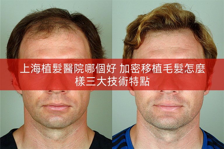 上海植髮醫院哪個好 加密移植毛髮怎麼樣三大技術特點