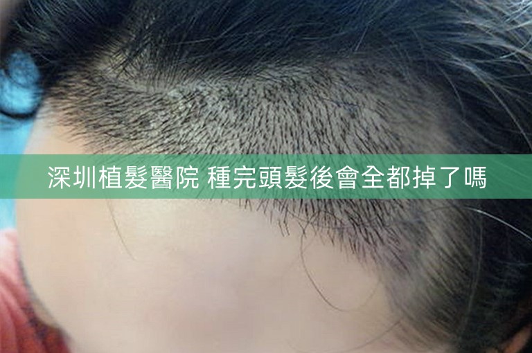 深圳植髮醫院 種完頭髮後會全都掉了嗎