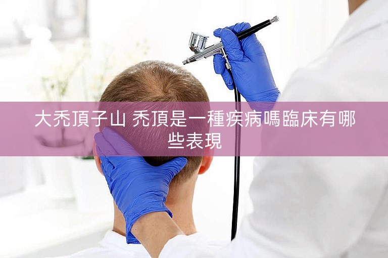 大禿頂子山 禿頂是一種疾病嗎臨床有哪些表現