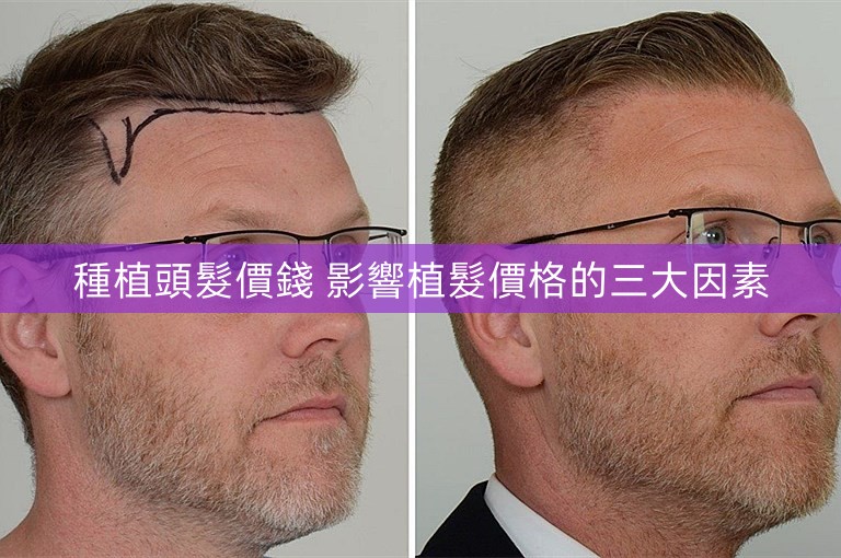 種植頭髮價錢 影響植髮價格的三大因素