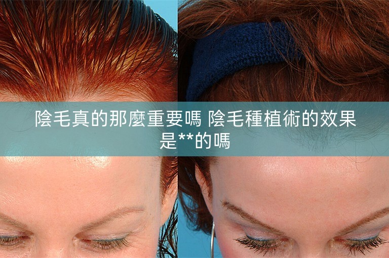 陰毛真的那麼重要嗎 陰毛種植術的效果是**的嗎 陰毛真的那麼重要嗎 陰毛種植術的效果是**的嗎
