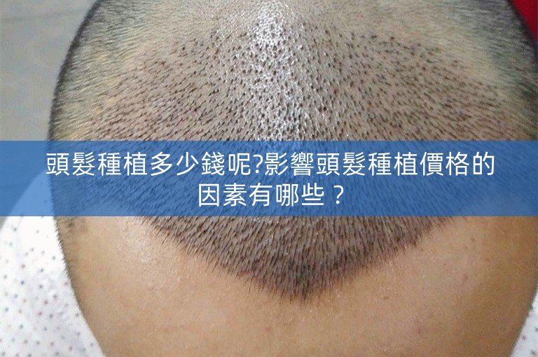 頭髮種植多少錢呢?影響頭髮種植價格的因素有哪些？