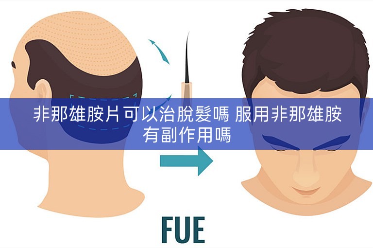 非那雄胺片可以治脫髮嗎 服用非那雄胺有副作用嗎 非那雄胺片可以治脫髮嗎 服用非那雄胺有副作用嗎