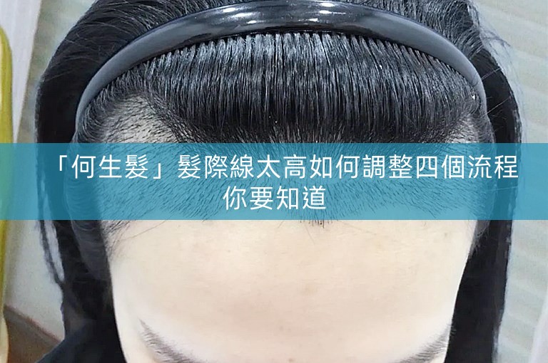 「何生髮」髮際線太高如何調整四個流程你要知道