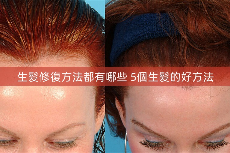 生髮修復方法都有哪些 5個生髮的好方法