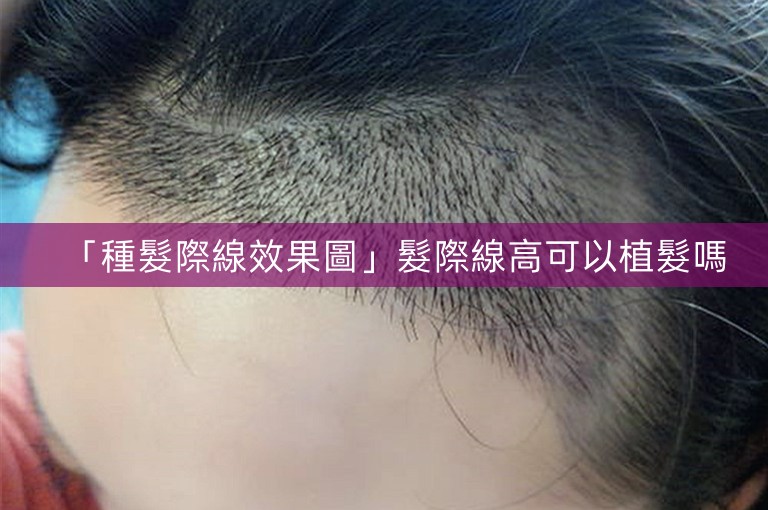 「種髮際線效果圖」髮際線高可以植髮嗎
