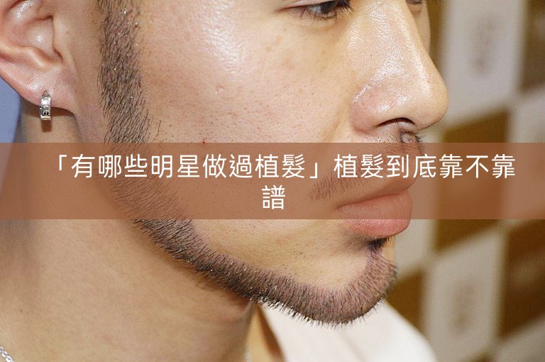 「有哪些明星做過植髮」植髮到底靠不靠譜