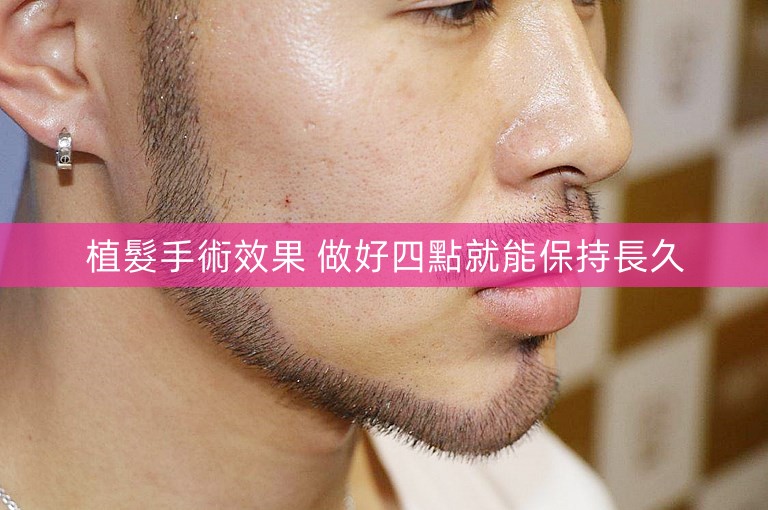 植髮手術效果 做好四點就能保持長久 植髮手術效果 做好四點就能保持長久