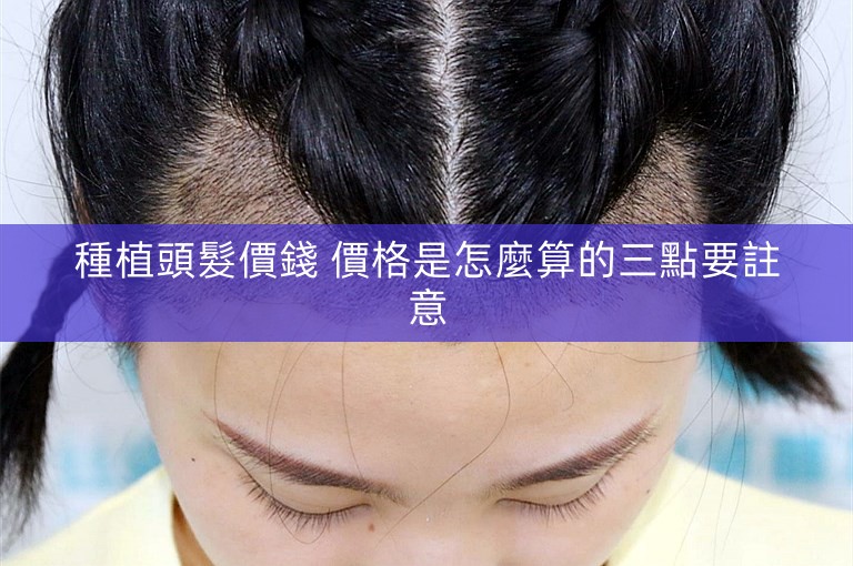 種植頭髮價錢 價格是怎麼算的三點要註意