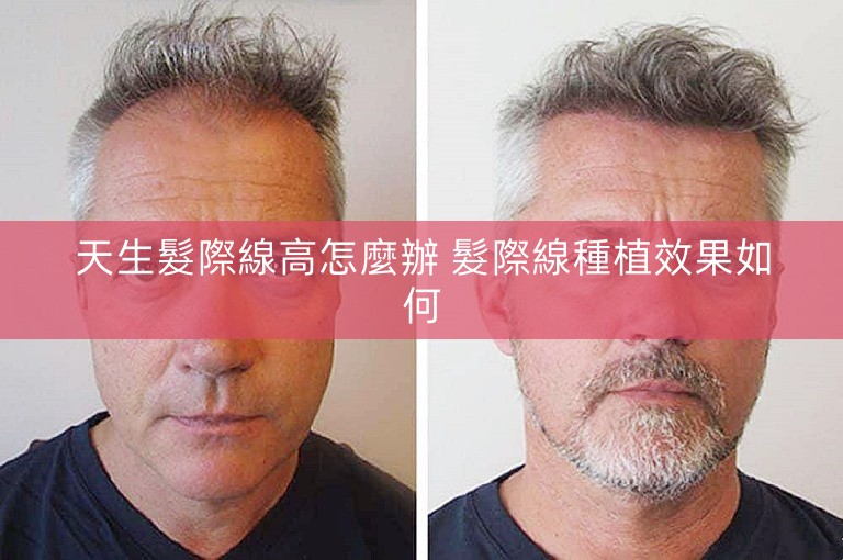 天生髮際線高怎麼辦 髮際線種植效果如何
