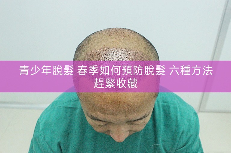 青少年脫髮 春季如何預防脫髮 六種方法趕緊收藏