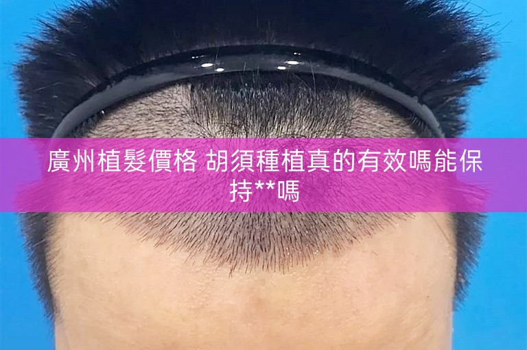 廣州植髮價格 胡須種植真的有效嗎能保持**嗎 廣州植髮價格 胡須種植真的有效嗎能保持**嗎