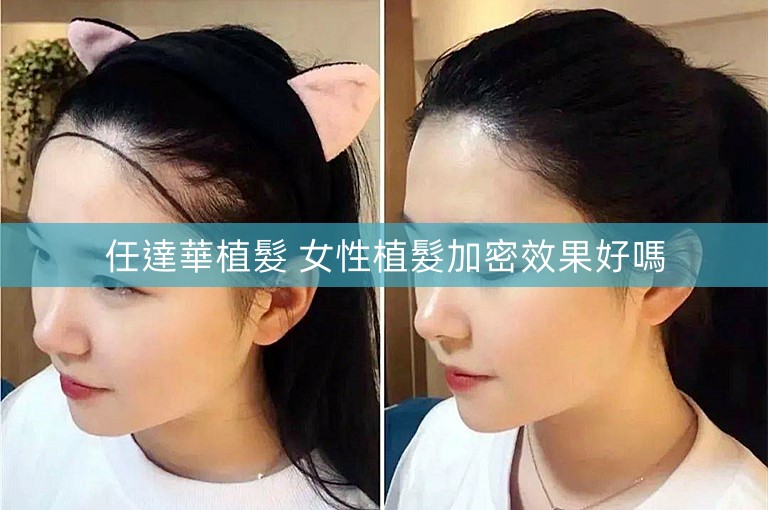 任達華植髮 女性植髮加密效果好嗎
