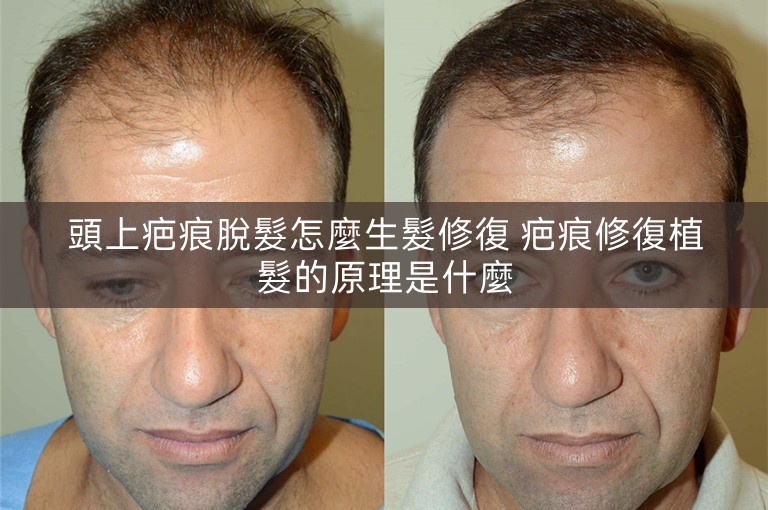 頭上疤痕脫髮怎麼生髮修復 疤痕修復植髮的原理是什麼 頭上疤痕脫髮怎麼生髮修復 疤痕修復植髮的原理是什麼