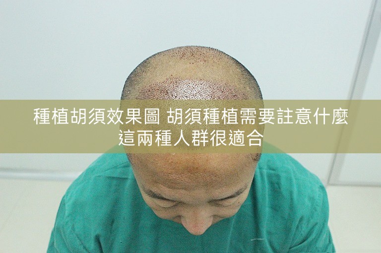 種植胡須效果圖 胡須種植需要註意什麼這兩種人群很適合 種植胡須效果圖 胡須種植需要註意什麼這兩種人群很適合