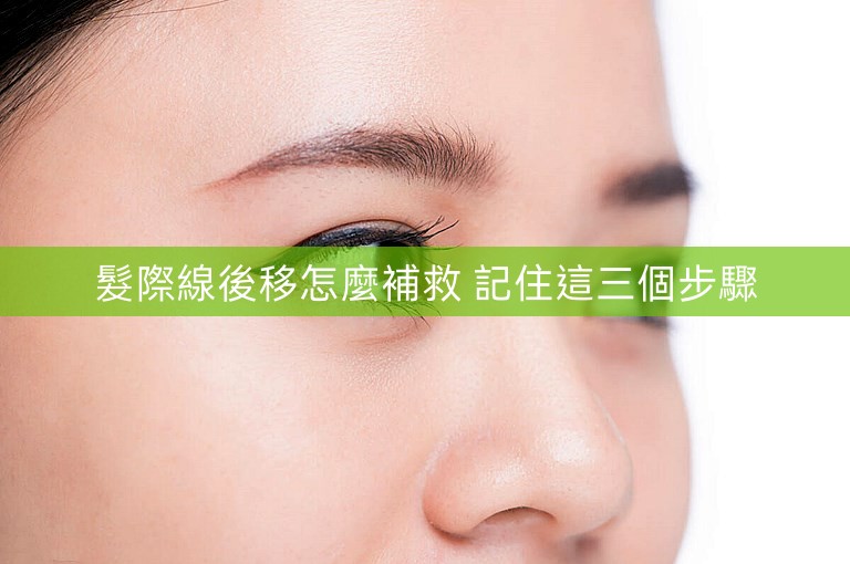 髮際線後移怎麼補救 記住這三個步驟