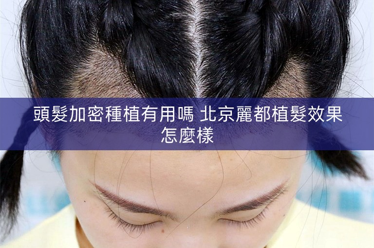 頭髮加密種植有用嗎 北京麗都植髮效果怎麼樣