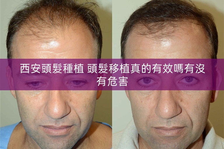 西安頭髮種植 頭髮移植真的有效嗎有沒有危害