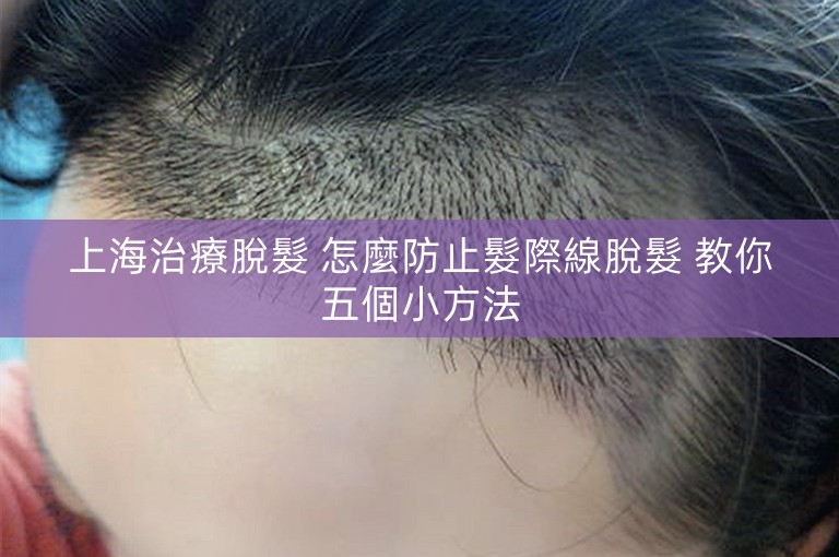 上海治療脫髮 怎麼防止髮際線脫髮 教你五個小方法 上海治療脫髮 怎麼防止髮際線脫髮 教你五個小方法