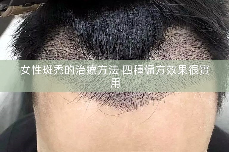 女性斑禿的治療方法 四種偏方效果很實用