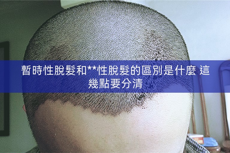 暫時性脫髮和**性脫髮的區別是什麼 這幾點要分清