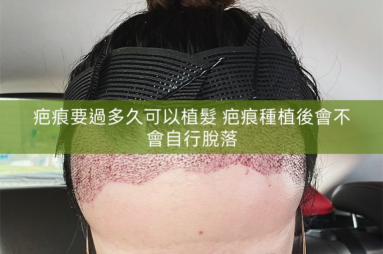 疤痕要過多久可以植髮 疤痕種植後會不會自行脫落 疤痕要過多久可以植髮 疤痕種植後會不會自行脫落