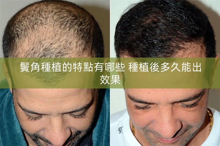 鬢角種植的特點有哪些 種植後多久能出效果