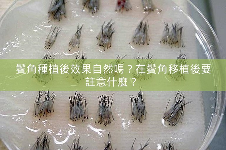 鬢角種植後效果自然嗎？在鬢角移植後要註意什麼？ 