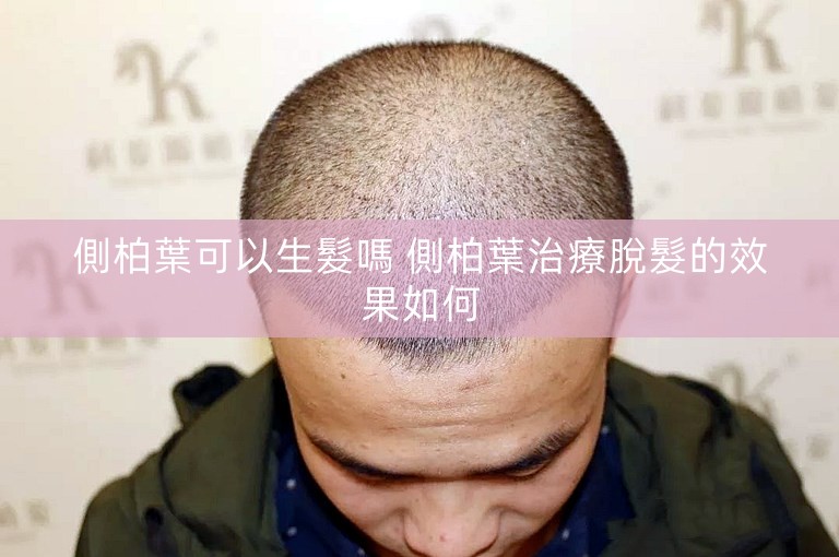 側柏葉可以生髮嗎 側柏葉治療脫髮的效果如何