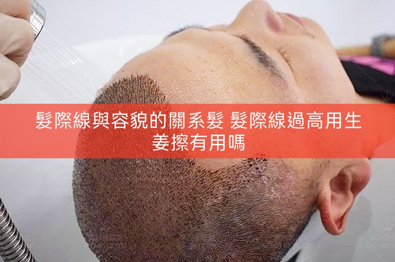 髮際線與容貌的關系髮 髮際線過高用生姜擦有用嗎