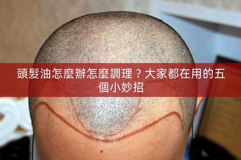 頭髮油怎麼辦怎麼調理？大家都在用的五個小妙招