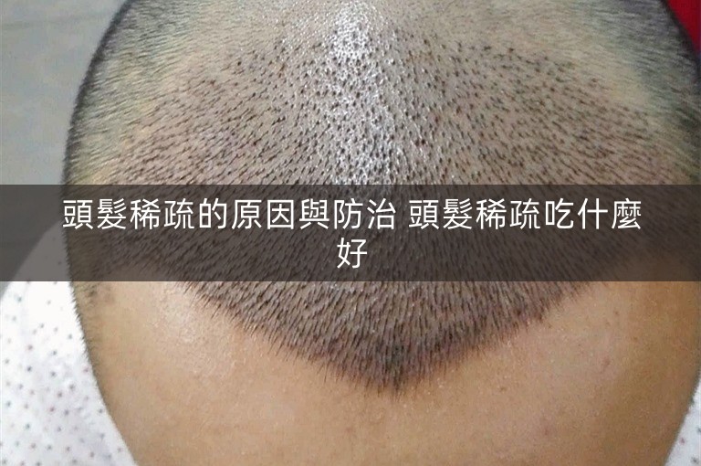 頭髮稀疏的原因與防治 頭髮稀疏吃什麼好