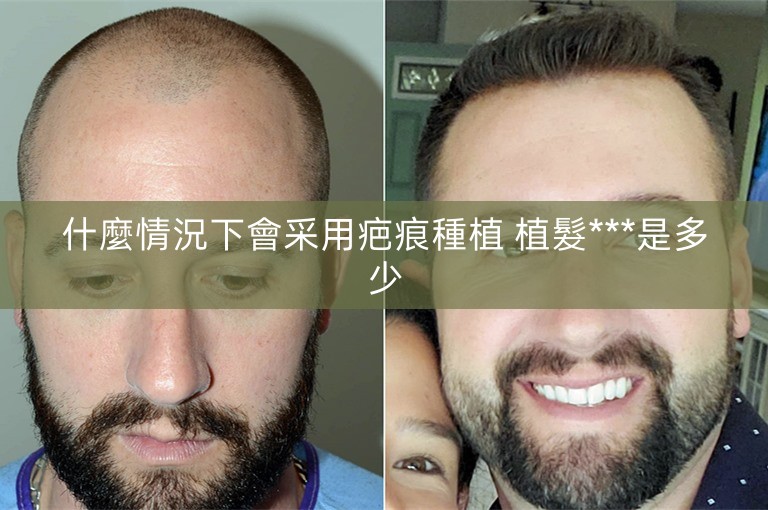 什麼情況下會采用疤痕種植 植髮***是多少