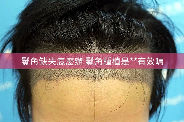 鬢角缺失怎麼辦 鬢角種植是**有效嗎