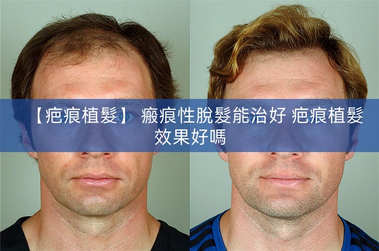 【疤痕植髮】 瘢痕性脫髮能治好 疤痕植髮效果好嗎 【疤痕植髮】 瘢痕性脫髮能治好 疤痕植髮效果好嗎