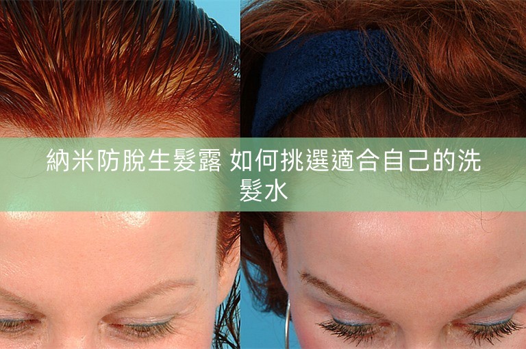 納米防脫生髮露 如何挑選適合自己的洗髮水