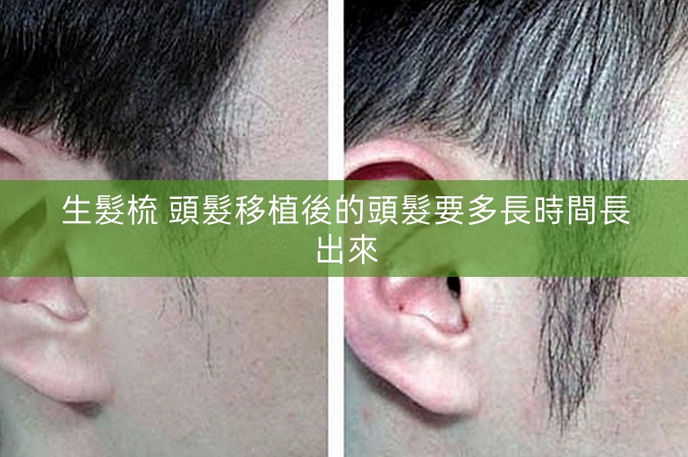 生髮梳 頭髮移植後的頭髮要多長時間長出來