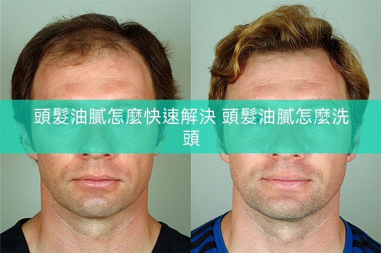 頭髮油膩怎麼快速解決 頭髮油膩怎麼洗頭