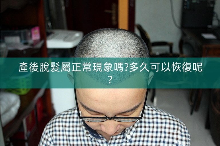 產後脫髮屬正常現象嗎?多久可以恢復呢?