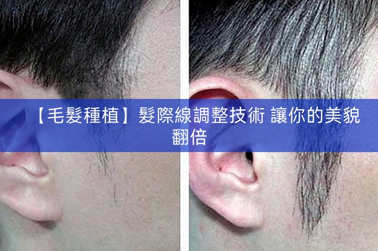 【毛髮種植】髮際線調整技術 讓你的美貌翻倍