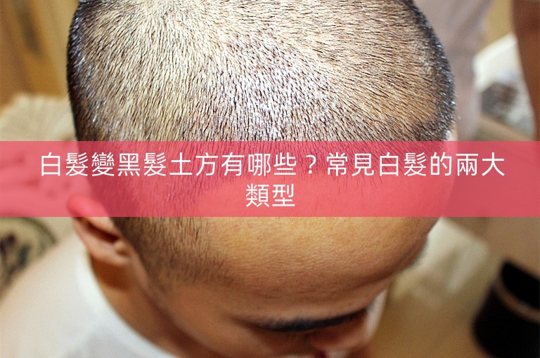 白髮變黑髮土方有哪些？常見白髮的兩大類型