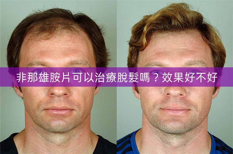 非那雄胺片可以治療脫髮嗎？效果好不好