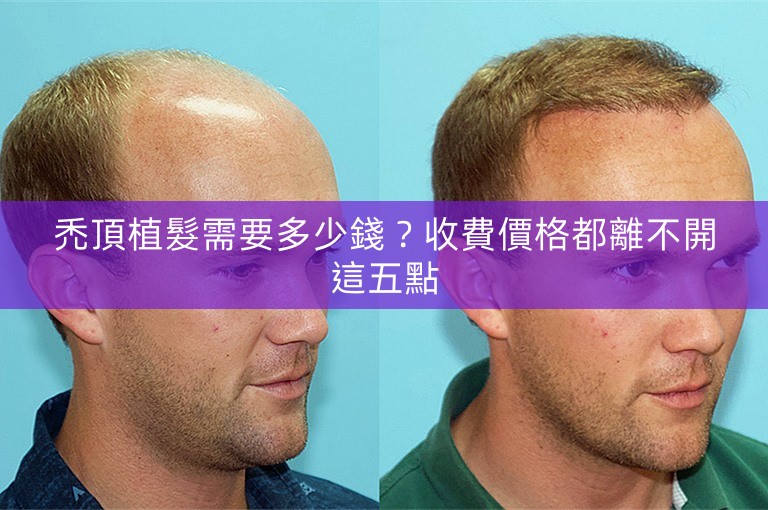 禿頂植髮需要多少錢？收費價格都離不開這五點