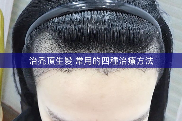 治禿頂生髮 常用的四種治療方法