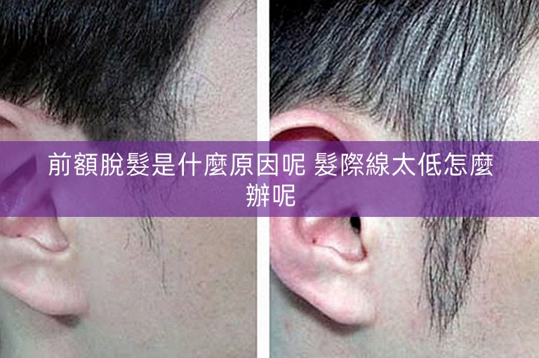前額脫髮是什麼原因呢 髮際線太低怎麼辦呢
