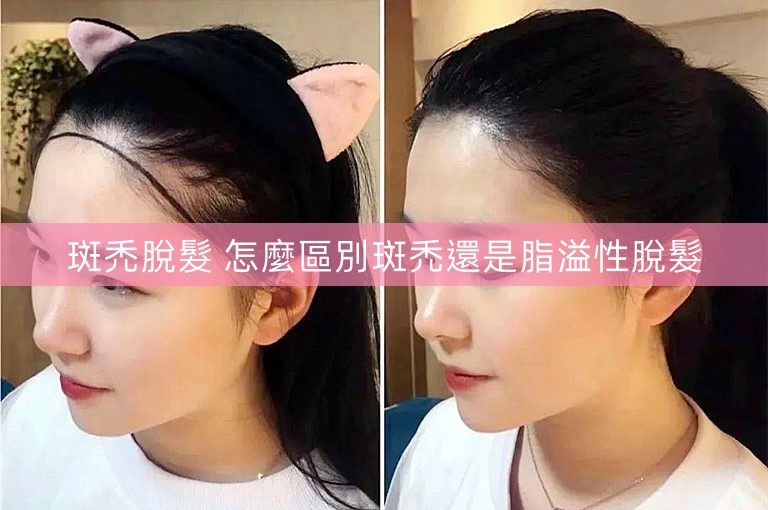 斑禿脫髮 怎麼區別斑禿還是脂溢性脫髮