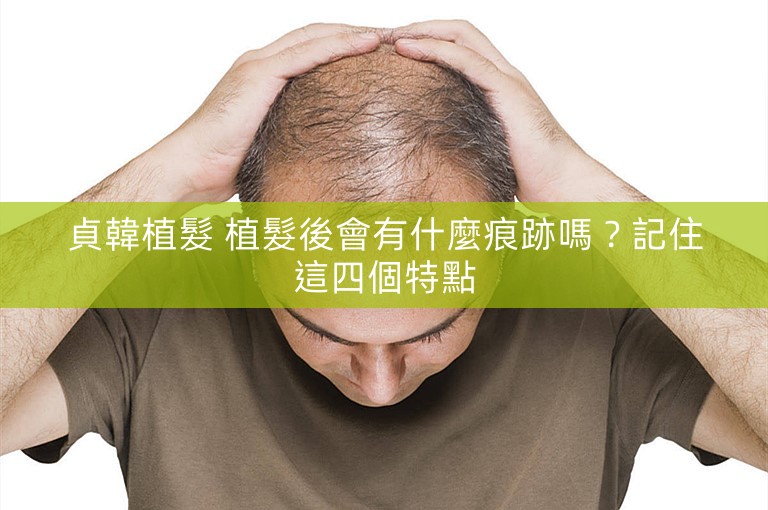 貞韓植髮 植髮後會有什麼痕跡嗎？記住這四個特點